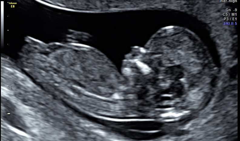 ungeborenes Kind 13. Woche