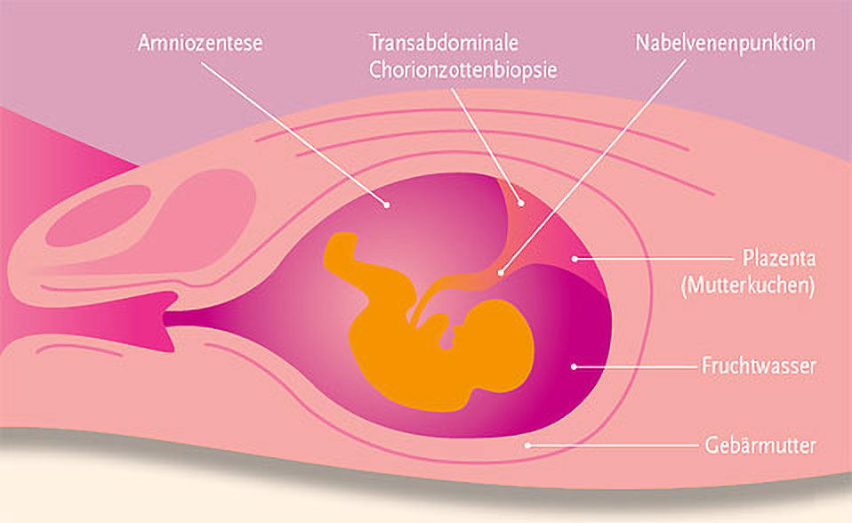 Durchführung von transabdominaler Chorionzottenbiopsie (durch die Bauchdecken), Amniozentese sowie Nabelvenenpunktion